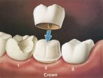 Dental Implants Albuquerque NM - W. Gregory Rose DDS, PA