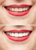 Teeth Whitening Albuquerque NM - W. Gregory Rose DDS, PA