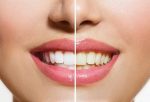 Teeth Whitening - Cure Dental