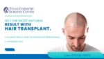 Hair Transplantation in Coimbatore