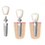 Implant-dental - Tooth Implant Sydney