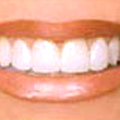 Teeth Whitening by a Cardiff Dentist